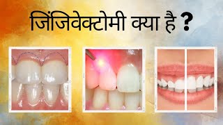 जिंजिवेक्टोमी क्या है   Gingivectomy in hindi [upl. by Gaves]