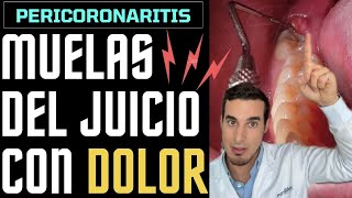 MUELA del JUICIO SALIENDO con dolor e inflamada  Así se ve una PERICORONARITIS [upl. by Belia]