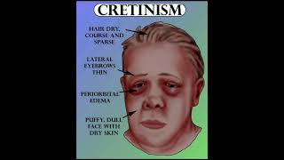 Cretinism disease 11thNEET PCS [upl. by Niveg899]