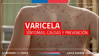 VARICELA Síntomas Causas y Prevención [upl. by Adnahcal]