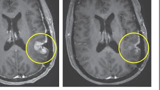 Early clinical trial results show dramatic progress against glioblastoma tumors [upl. by Zindman]