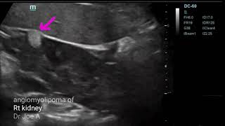 Angiomyolipoma of right kidney ultrasound video [upl. by Namsaj]