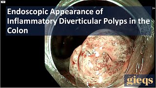 Endoscopic Appearance of Inflammatory Diverticular Polyps in the Colon [upl. by Oirram]