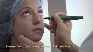 Chirurgie des cernes  Lipostructure du cerne [upl. by Lemahs83]