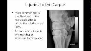 Carpus Injuries m4v [upl. by Liggitt]