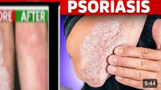 ECZEMA PSORIASIS KA TREATMENT [upl. by Wolfy491]