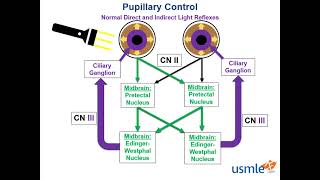 Relative Afferent Pupillary Defect  Marcus Gunn Pupil [upl. by Aiksas845]