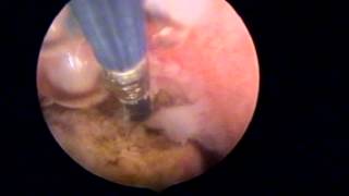 Resection Hystéroscopique de Polype Electrode Bipolaire 5 Fr [upl. by Lattie961]