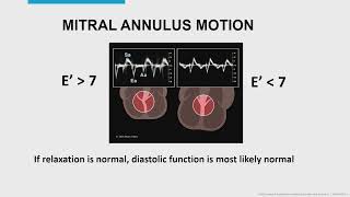 EVALUATION OF DIASTOLIC DYSFUNCTION THE BASICSMAYO CLINIC [upl. by Rossie]