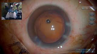 1 hour 8 cases Dr Sourabh Patwardhan Live Cataract surgery For consultation call 7028402375 [upl. by Nalac]