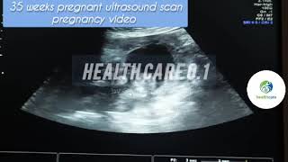 35 weeks pregnant baby ultrasound scan pregnancy video pregnancy ultrasound baby scan video [upl. by Loftis682]