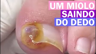 Tinha um miolo saindo do dedo Renata Werneck Podóloga Unha Encravada REMOVE INGROWN NAIL [upl. by Jeaz898]