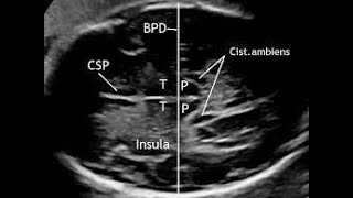 How to measure Biparietal diameter by Ultrasonography [upl. by Netnerb41]