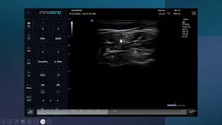 Ultrasound guided Interscalene brachial plexus nerve block [upl. by Kampmann]