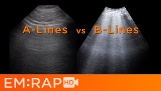 Ultrasound of Pulmonary Edema [upl. by Ecnal114]