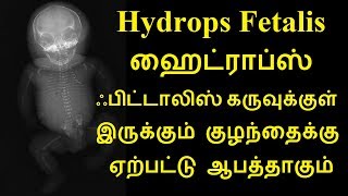 Hydrops Fetalis ஹைட்ராப்ஸ் ஃபிட்டாலிஸ் கருவுக்குள் இருக்கும் குழந்தைக்கு ஏற்பட்டு ஆபத்தாகும் [upl. by Llimaj]