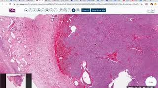 Steroid cell tumor of the ovary [upl. by Farra]