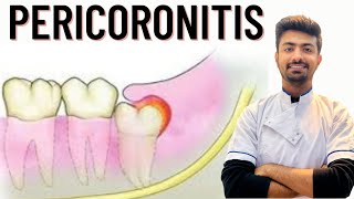 Pericoronitis Causes  Treatment [upl. by Allrud793]