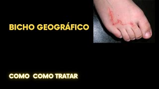 Bicho geográfico como tratar [upl. by Hanafee993]