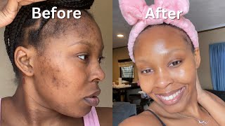 How I Cleared My Acne  Dark Spots  Hyperpigmentation for good in 1 month NO ACCUTANE VIDEO PROOF [upl. by Hildagarde336]