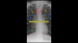 Bronquiectasias no RX [upl. by Aicirtac]