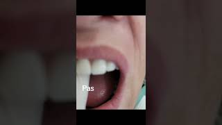 Proteza me super vakum dentist goviral dentistry smiledentist dentalclinic viral [upl. by Narok]