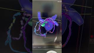 RCA CTO  epicardial proximal  distal LCX collateral system  heart navigator [upl. by Nari]