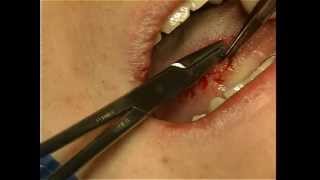 Excisional Biopsy of Tongue Lesion [upl. by Artenra556]