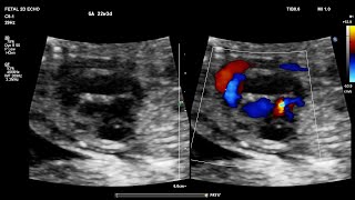 Clues to fetal echo Ebstein anomaly with VSD Dr Parag Bhalgat [upl. by Clorinda16]