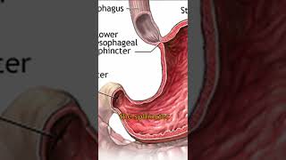 Abscess and Fistula Treatment  Low vs High Level Procedures [upl. by North]