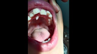 supernumerary teeth treatment  extra teeth treatment subscribe like 🦷 [upl. by Esme]