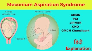 Meconium Aspiration Syndrome  Hindi lecture by Nirmla Kumari  Nursinginnovationhindi [upl. by Rimhsak]