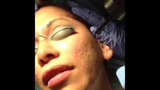 Acne Scarring Treated with Mixto CO2 laser Dr David Rahimi Forever Young Inc [upl. by Cline]