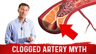 The Clogged Artery Myth – Dr Berg [upl. by Vanzant]