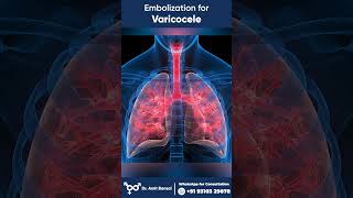 Varicocele I Varicocele Embolization I Embolization for Varicocele [upl. by Spurgeon]