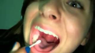 Gnarly Tonsil Stone Removal THE SEQUEL  How To ManageGet Rid Of Tonsil Stones [upl. by Theo596]