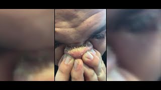 DIY Blackhead Removal Goes Viral [upl. by Haisi]