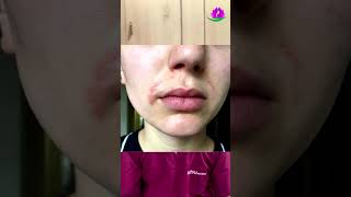 Excessive facial hair in women  Hirsutism  Sarojini Skin Care  Dr Prateek Maharana [upl. by Nylecaj194]