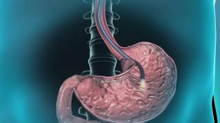 Learn about gastroscopy [upl. by Aicnom]