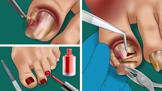 ASMR Ingrown Toenail Removal Treatment Animation  WOW Brain Satisfyingvideo [upl. by Judas]