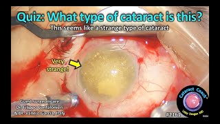 CataractCoach™ 2161 Quiz What type of cataract is this [upl. by Nimesh]