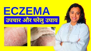 Eczema Treatment  Eczema Ka Ilaj Home Remedies Aur Precautions [upl. by Nodnrb]