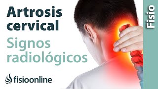 Artrosis cervical  Signos radiológicos [upl. by Jenkel]