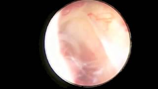 Endoscopic Third Ventriculostomy [upl. by Asilem]