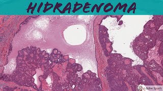 Nodular Hidradenoma Acrospiroma 5Minute Pathology Pearls [upl. by Odnam]