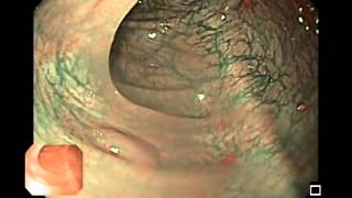 Hyperplastic Colon Polyps [upl. by Filia]