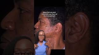 Causes of Brown Bumps on the Face Dermatosis Papulosa Nigra DPN and Treatment [upl. by Ramin]