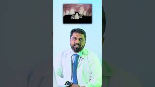 4 Types of Replacing Front Teeth  Dr Prem Alex Lawrence in Tamil [upl. by Llenrap597]