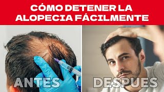 Derrota la alopecia Métodos efectivos 😊 [upl. by Oberon]