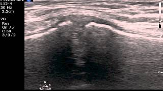 Manubriosternal joint MSKUS ultrasound [upl. by Jolee722]